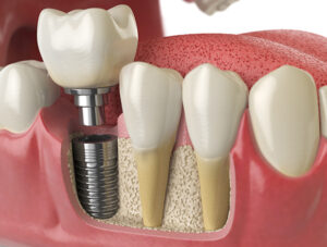 dental-implant-procedure-north-york