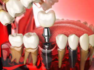 dental-implants-north-york