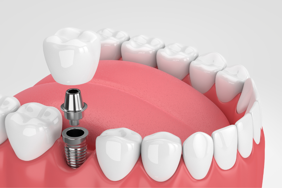 dental-implants-north-york-dentist